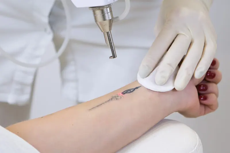 Laser-Tattoo-Removal